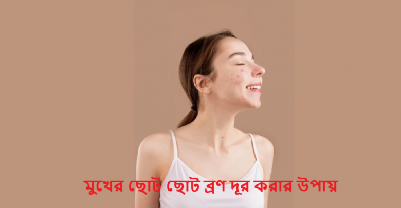 মুখের ছোট ছোট ব্রণ দূর করার উপায়