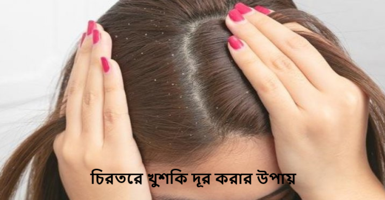 চিরতরে খুশকি দূর করার উপায়